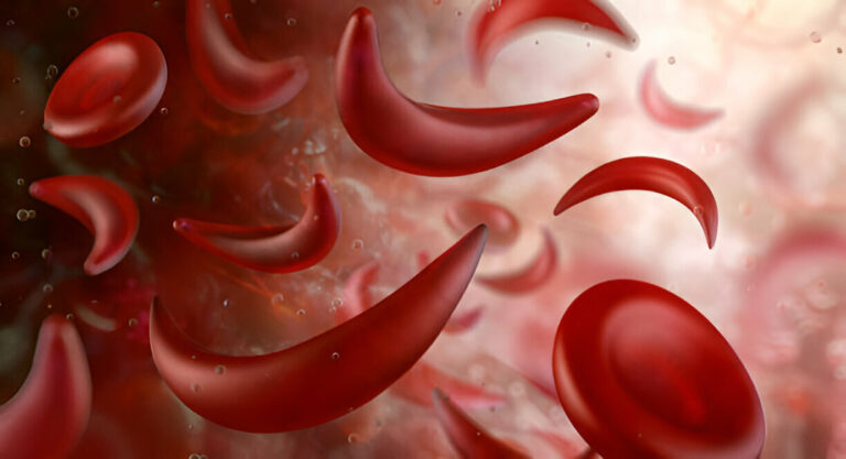 Sickle cell anemia