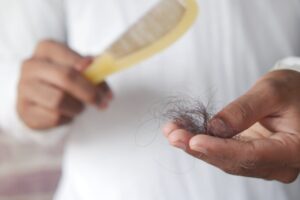 Vitamin D deficiency causes hair loss.